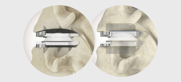 Centinel Spine® Announces 500th Procedure with prodisc® C Vivo and prodisc C SK Cervical Total Disc Replacement System
